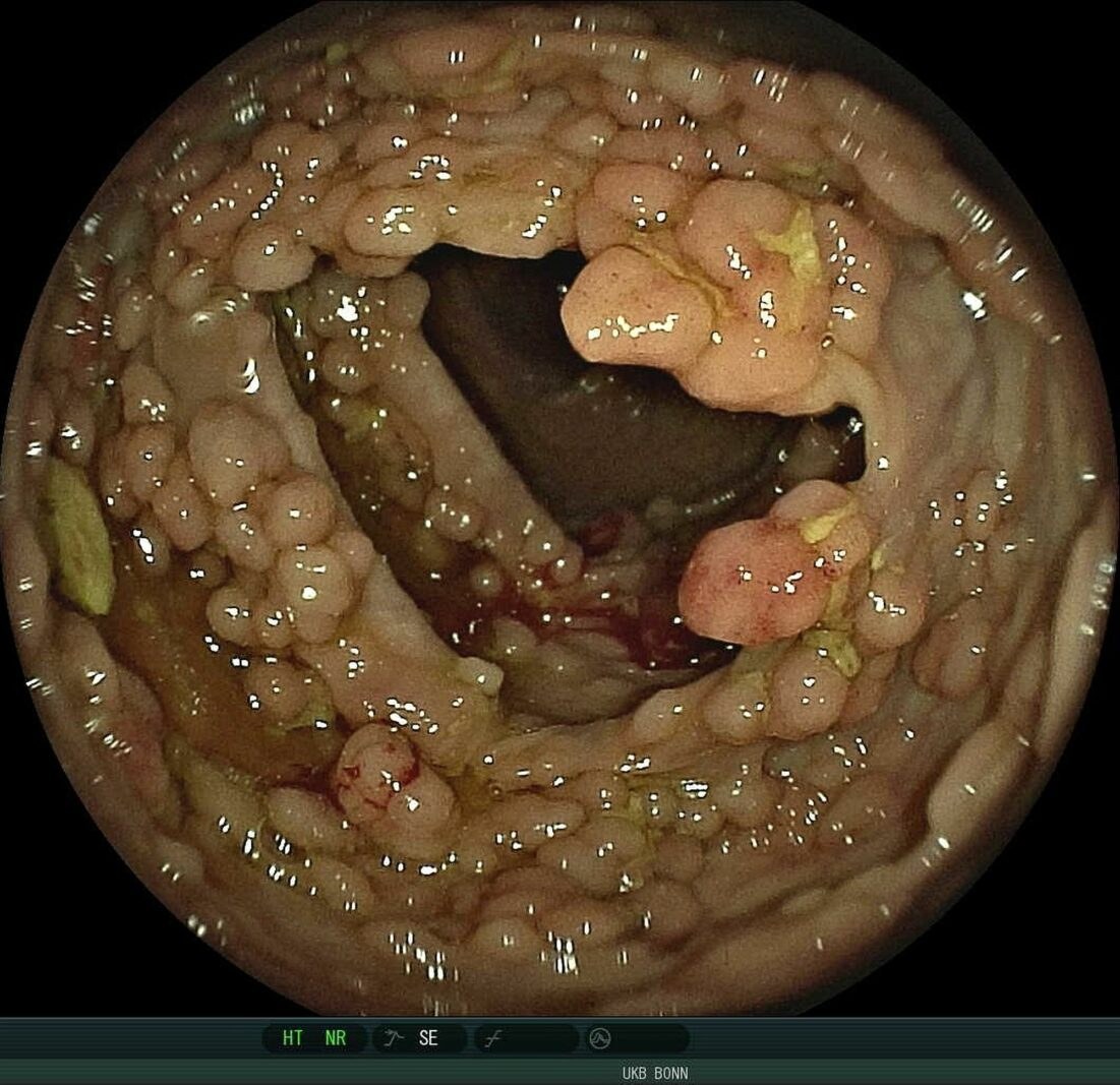 Bei Patientinnen und Patienten mit der Diagnose „familiäre adenomatöse Polyposis“, kurz FAP, bilden sich bis zu tausende von Polypen im Darm, ohne eine entsprechende Behandlung ist bei ihnen Darmkrebs zu 100 Prozent vorprogrammiert. Ein Projekt der Universitätskliniken Würzburg und Bonn, gefördert von der Wilhelm Sander-Stiftung, erforscht nun die Entwicklung und den Einsatz eines KI-Polypenerkennungssystems, um die Darmkrebsvorsorge bei Betroffenen mit FAP zu verbessern