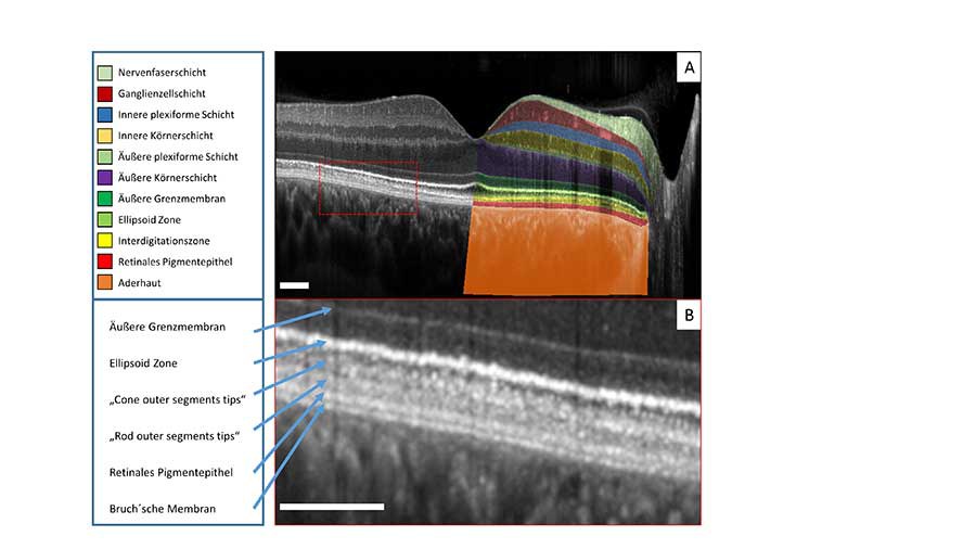 High-resolution OCT (high-res OCT) Schnitt durch die Fovea